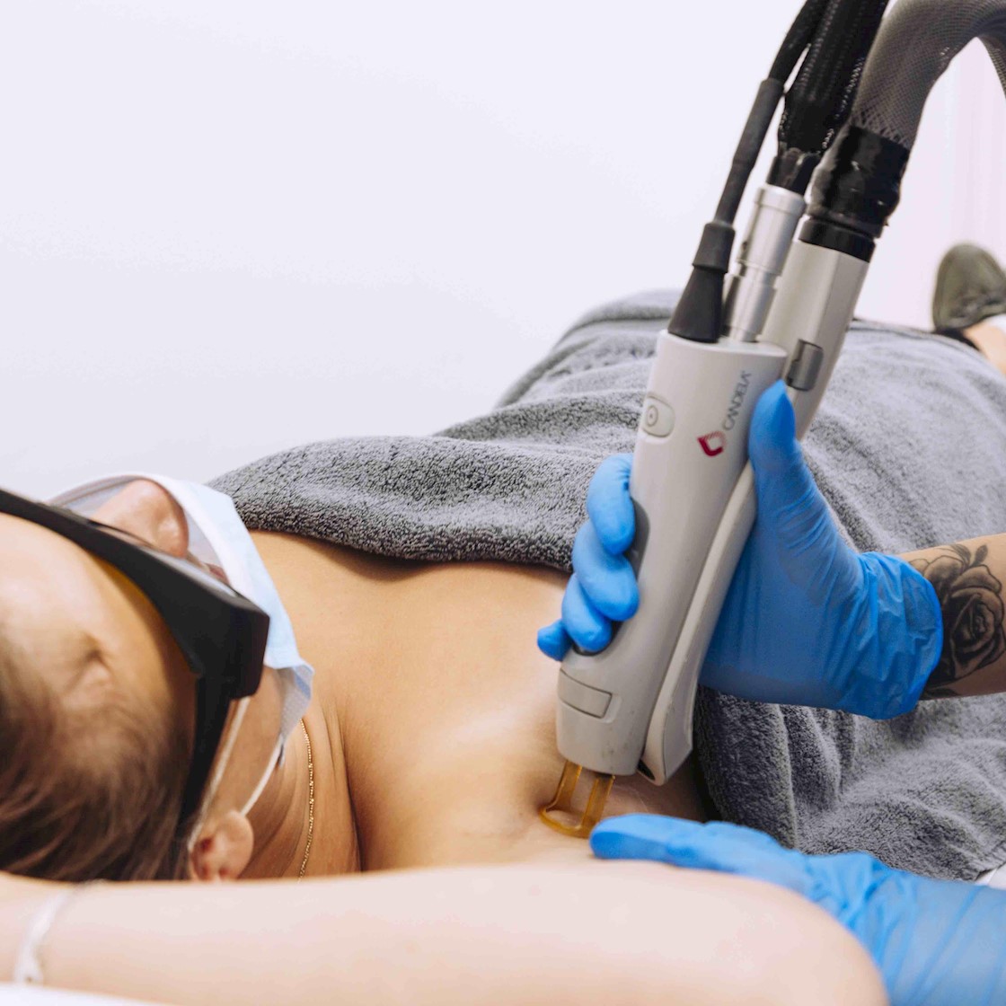 Laser Hair Removal