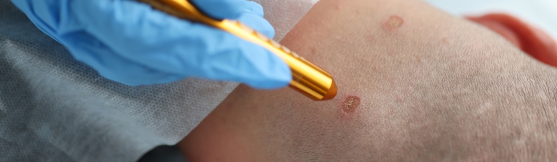 close up of dermatologist treating a skin wart for safe wart removal in clinic