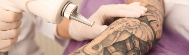 Laser tattoo removal process with advanced laser targeting unwanted ink explained