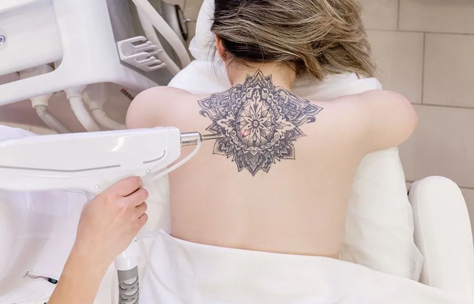 Laser Tattoo Removal