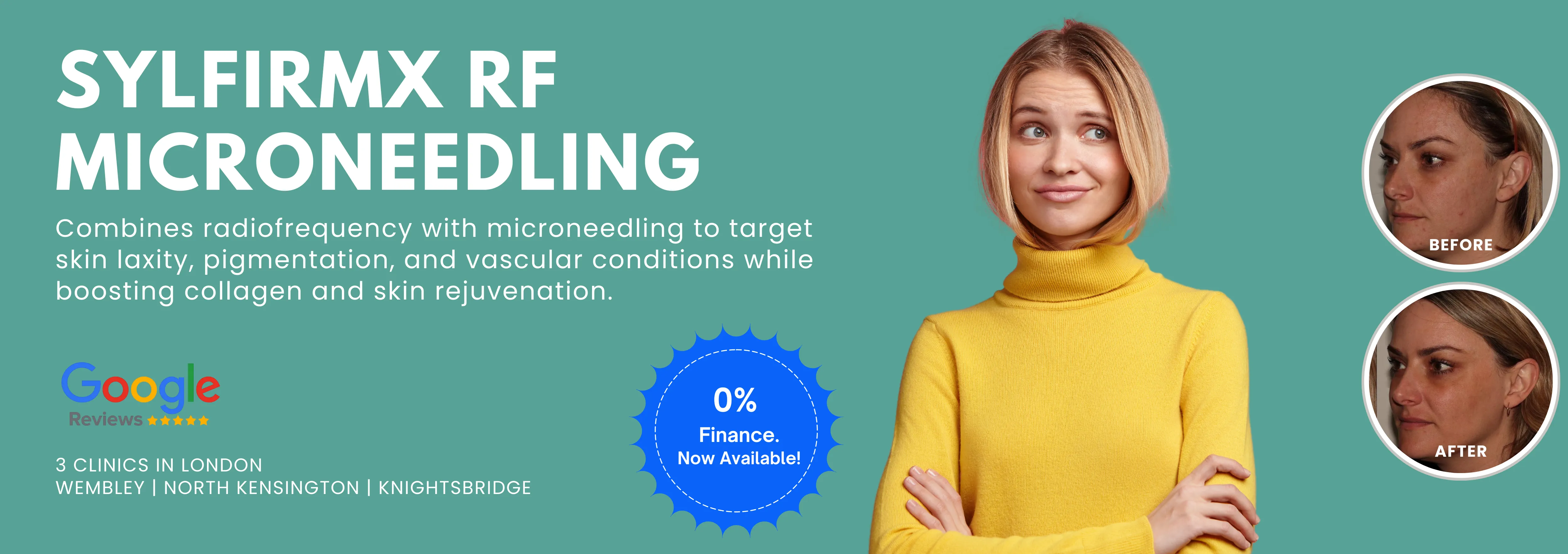 RF Microneedling